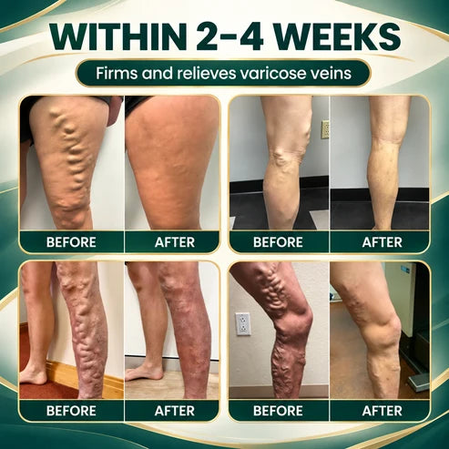 Lyyeto® Varicose Veins Cream